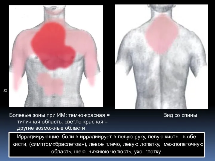 Болевые зоны при ИМ: темно-красная = типичная область, светло-красная =