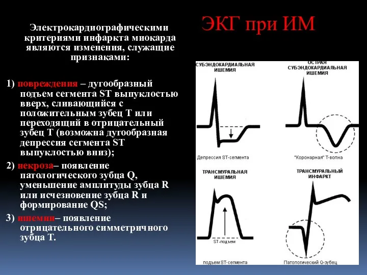 ЭКГ при ИМ Электрокардиографическими критериями инфаркта миокарда являются изменения, служащие