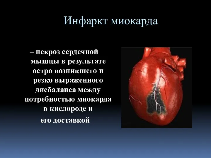 Инфаркт миокарда – некроз сердечной мышцы в результате остро возникшего