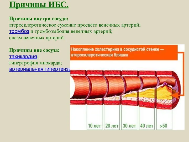 Причины ИБС. Причины внутри сосуда: атеросклеротическое сужение просвета венечных артерий; тромбоз и тромбоэмболия