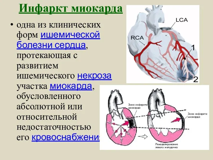 Инфаркт миокарда одна из клинических форм ишемической болезни сердца, протекающая с развитием ишемического