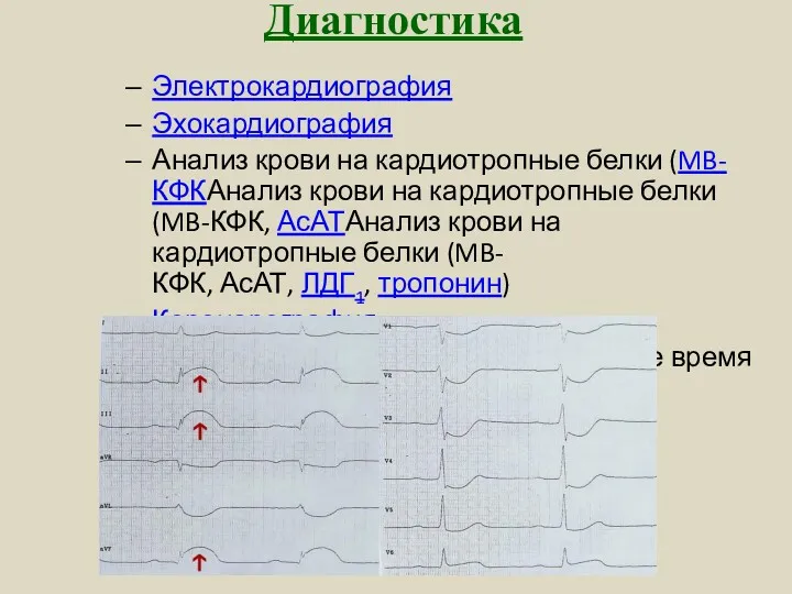 Диагностика Электрокардиография Эхокардиография Анализ крови на кардиотропные белки (MB-КФКАнализ крови