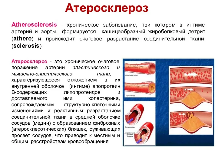 Атеросклероз Атеросклероз - это хроническое очаговое поражение артерий эластического и