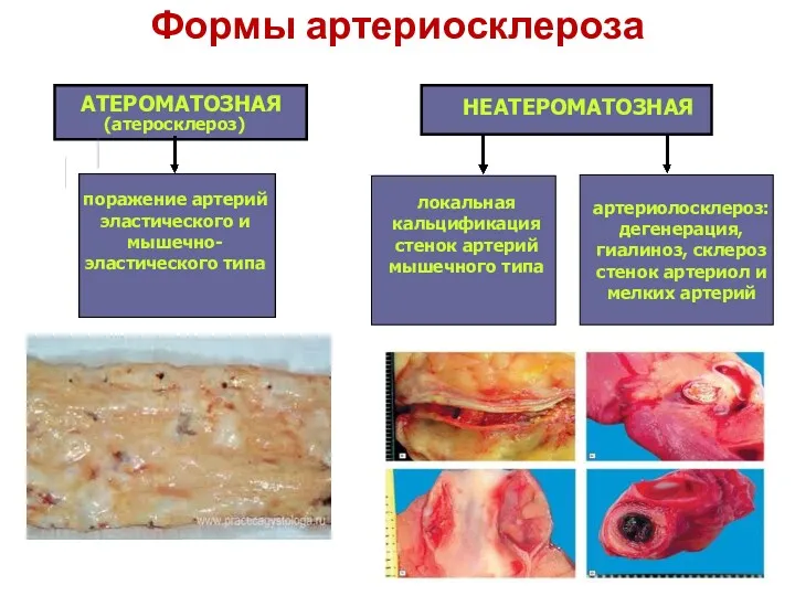 Формы артериосклероза поражение артерий эластического и мышечно-эластического типа артериолосклероз: дегенерация,