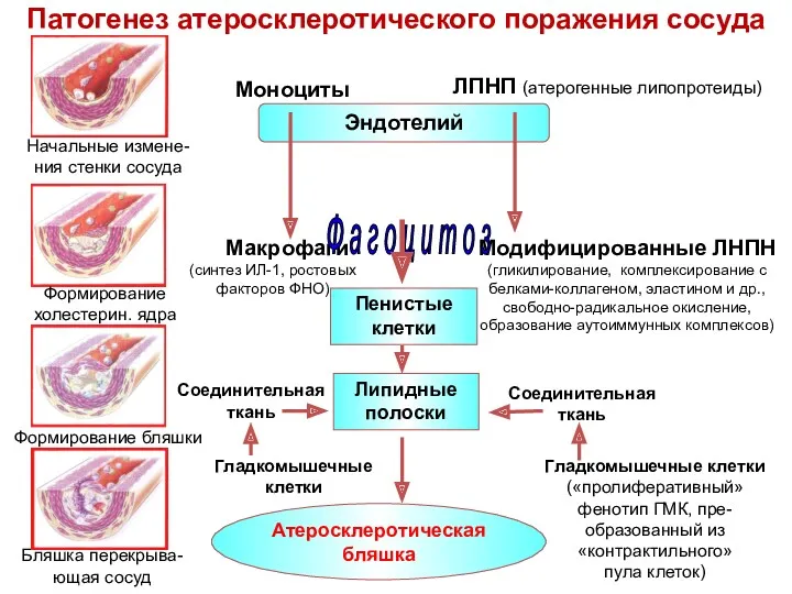 Патогенез атеросклеротического поражения сосуда Эндотелий Моноциты ЛПНП (атерогенные липопротеиды) Макрофаги