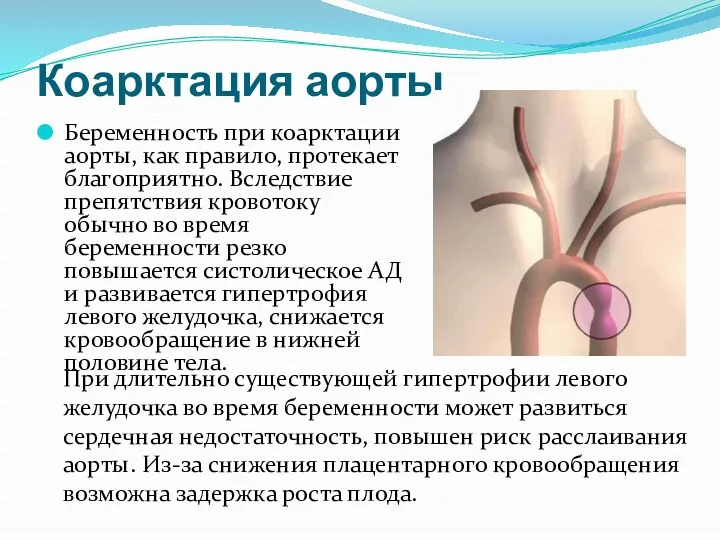 Коарктация аорты Беременность при коарктации аорты, как правило, протекает благоприятно.