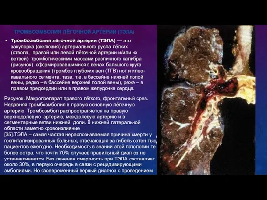 . яч м ТРОМБОЭМБОЛИЯ ЛЁГОЧНОЙ АРТЕРИИ (ТЭЛА) Тромбоэмболия лёгочной артерии (ТЭЛА) — это