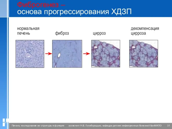 Фиброгенез – основа прогрессирования ХДЗП нормальная печень фиброз цирроз декомпенсация цирроза