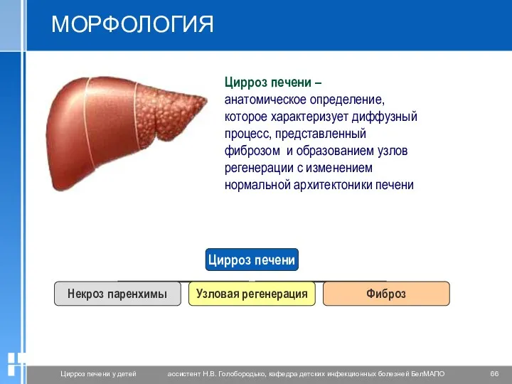 Цирроз печени – анатомическое определение, которое характеризует диффузный процесс, представленный