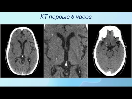 КТ первые 6 часов