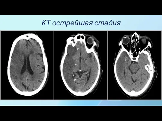 КТ острейшая стадия