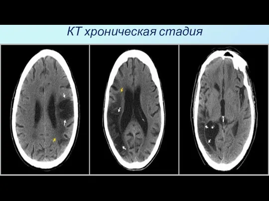 КТ хроническая стадия