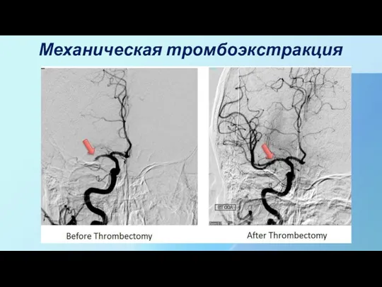 Механическая тромбоэкстракция