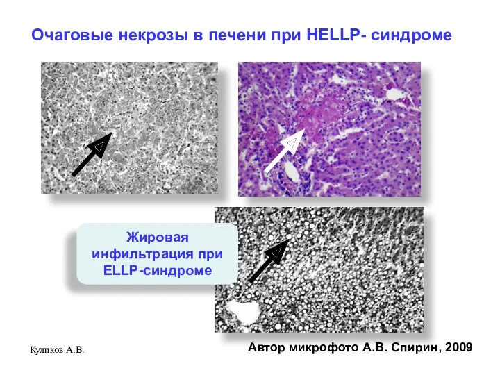 Куликов А.В. Очаговые некрозы в печени при HELLP- синдроме Автор