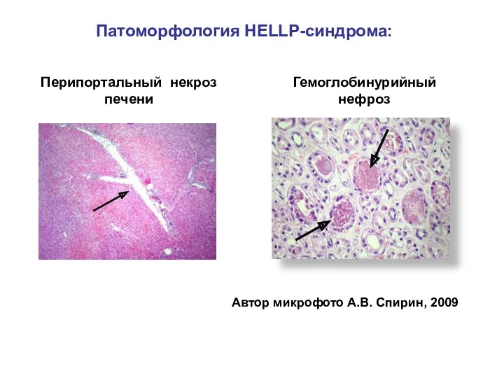 Перипортальный некроз печени Автор микрофото А.В. Спирин, 2009 Гемоглобинурийный нефроз Патоморфология HELLP-синдрома: