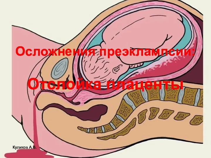 Осложнения преэклампсии: Отслойка плаценты Куликов А.В.