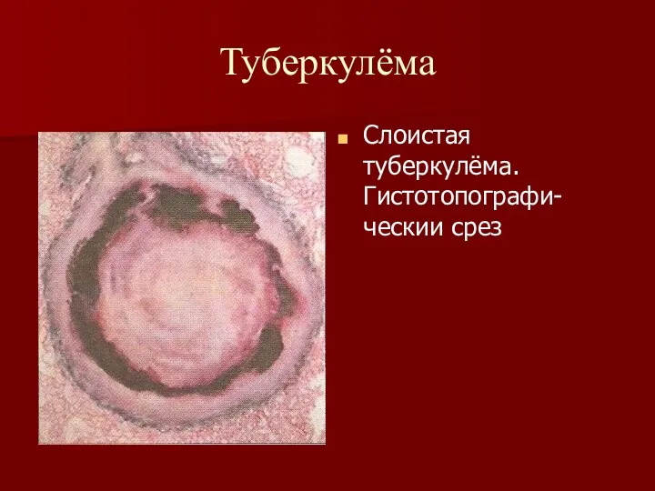 Туберкулёма Слоистая туберкулёма. Гистотопографи-ческии срез