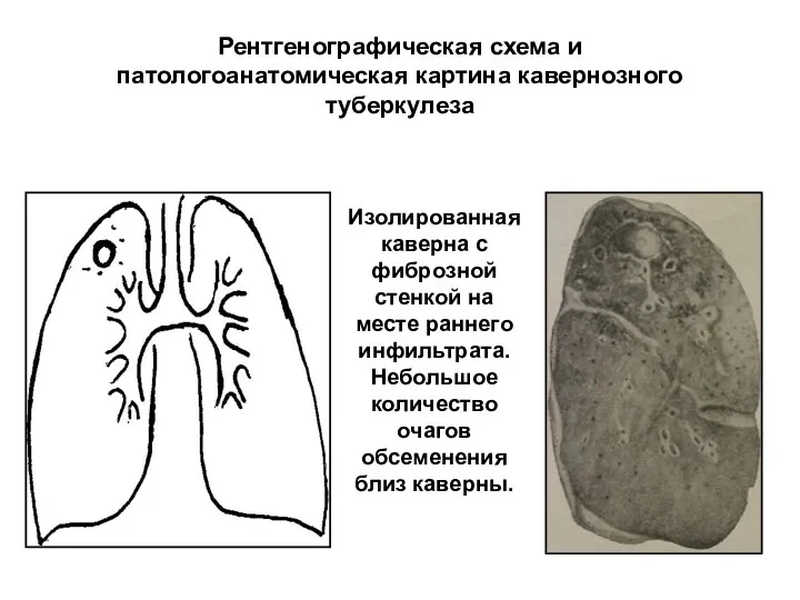 Рентгенографическая схема и патологоанатомическая картина кавернозного туберкулеза Изолированная каверна с фиброзной стенкой на