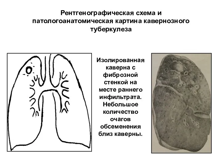 Рентгенографическая схема и патологоанатомическая картина кавернозного туберкулеза Изолированная каверна с