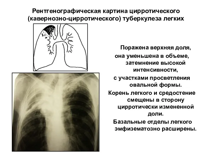 Рентгенографическая картина цирротического (кавернозно-цирротического) туберкулеза легких Поражена верхняя доля, она уменьшена в объеме,