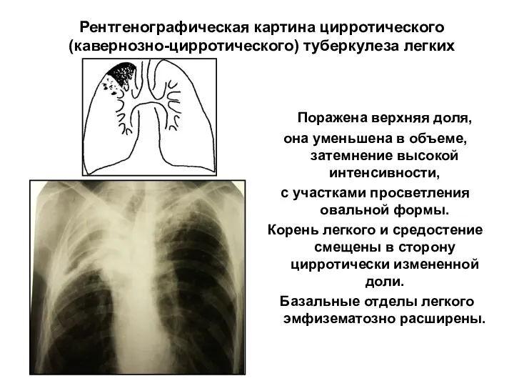 Рентгенографическая картина цирротического (кавернозно-цирротического) туберкулеза легких Поражена верхняя доля, она