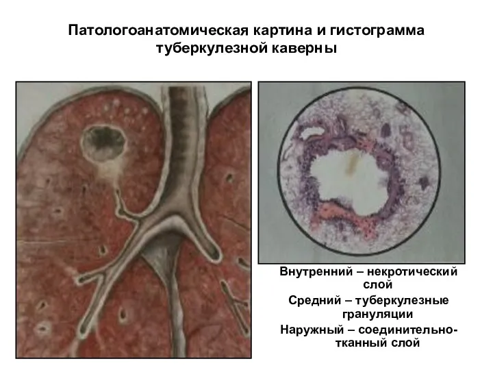Патологоанатомическая картина и гистограмма туберкулезной каверны Внутренний – некротический слой Средний – туберкулезные