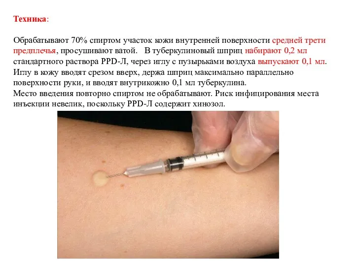 Техника: Обрабатывают 70% спиртом участок кожи внутренней поверхности средней трети