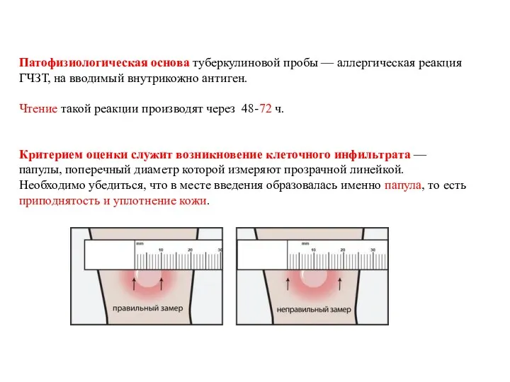 Патофизиологическая основа туберкулиновой пробы — аллергическая реакция ГЧЗТ, на вводимый