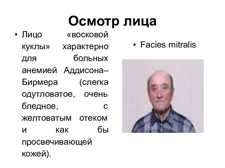 Осмотр лица Лицо «восковой куклы» характерно для больных анемией Аддисона–Бирмера