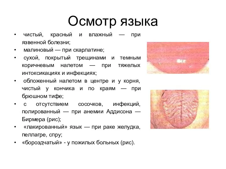 Осмотр языка чистый, красный и влажный — при язвенной болезни;