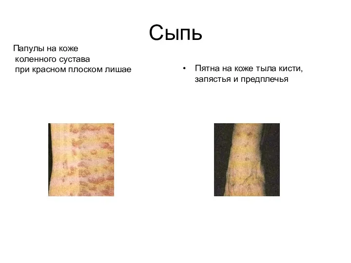 Сыпь Пятна на коже тыла кисти, запястья и предплечья Папулы