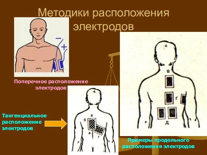 Методики расположения электродов Поперечное расположение электродов Примеры продольного расположения электродов Тангенциальное расположение электродов