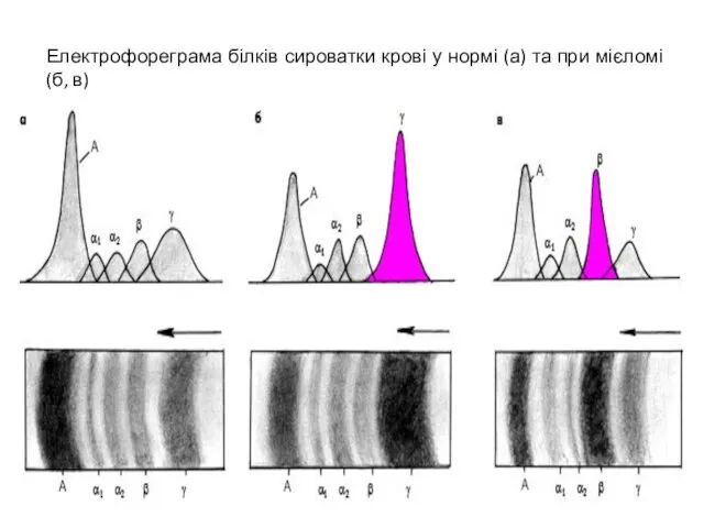 Електрофореграма білків сироватки крові у нормі (а) та при мієломі (б, в)