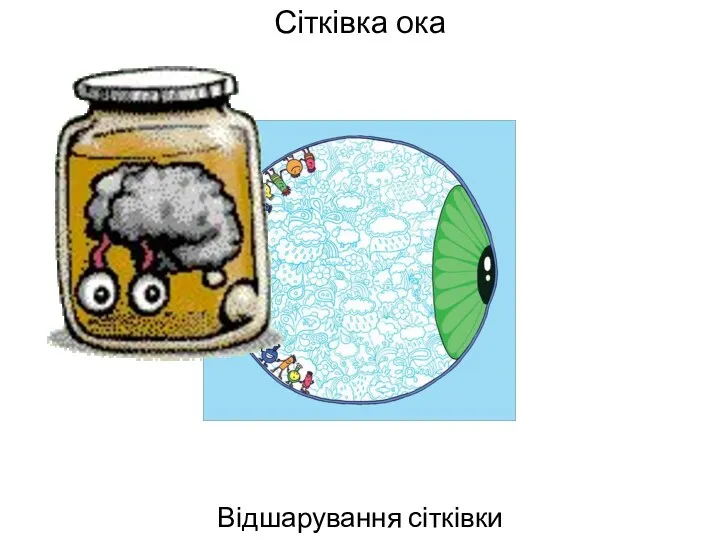 Сітківка ока Відшарування сітківки