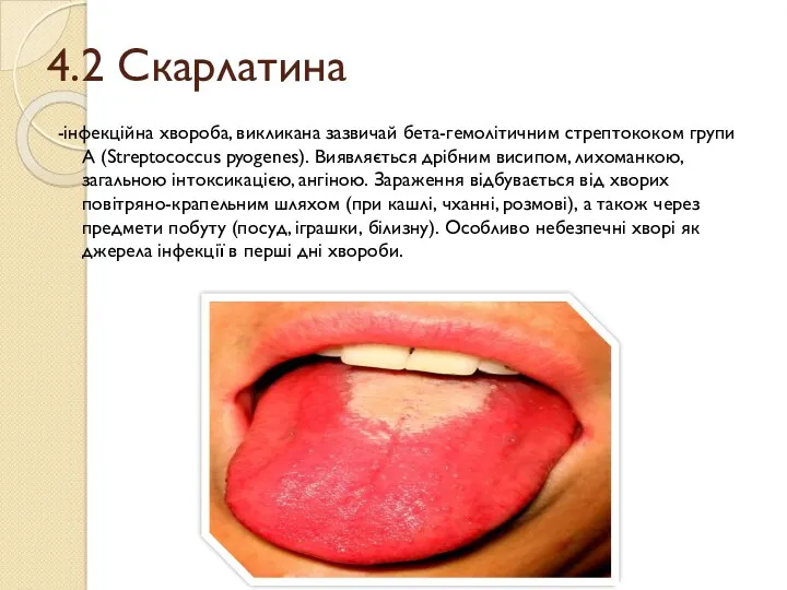 4.2 Скарлатина -інфекційна хвороба, викликана зазвичай бета-гемолітичним стрептококом групи А