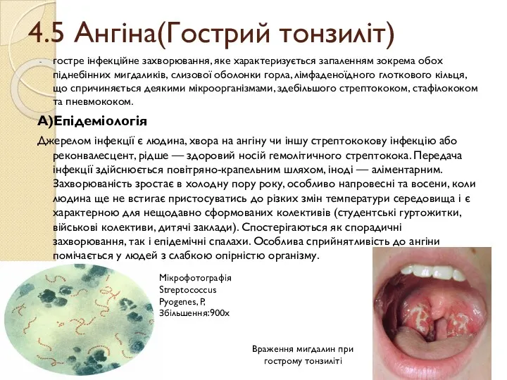 4.5 Ангіна(Гострий тонзиліт) гостре інфекційне захворювання, яке характеризується запаленням зокрема