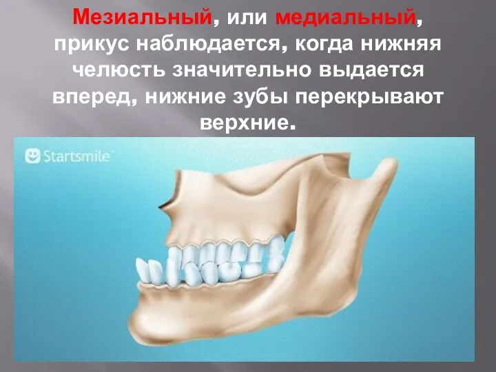 Мезиальный, или медиальный, прикус наблюдается, когда нижняя челюсть значительно выдается вперед, нижние зубы перекрывают верхние.