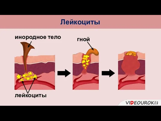 Лейкоциты инородное тело лейкоциты гной