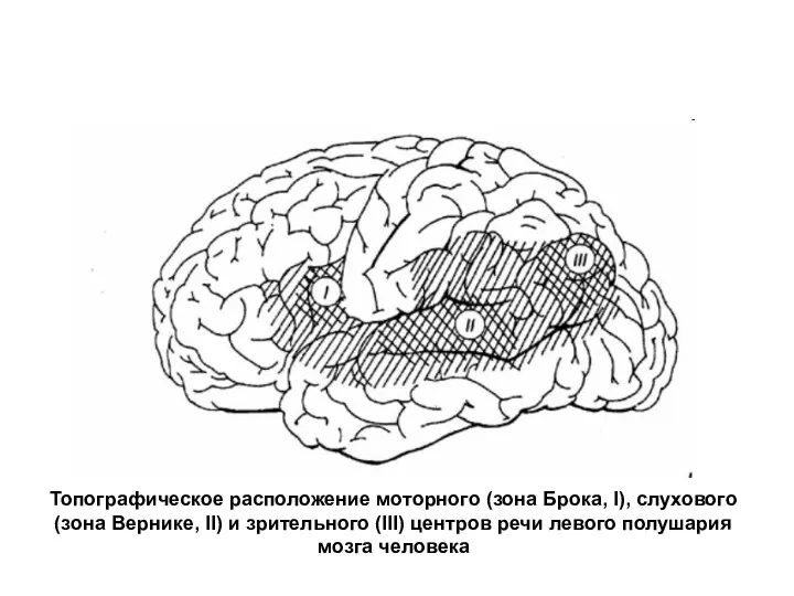 Топографическое расположение моторного (зона Брока, I), слухового (зона Вернике, II)