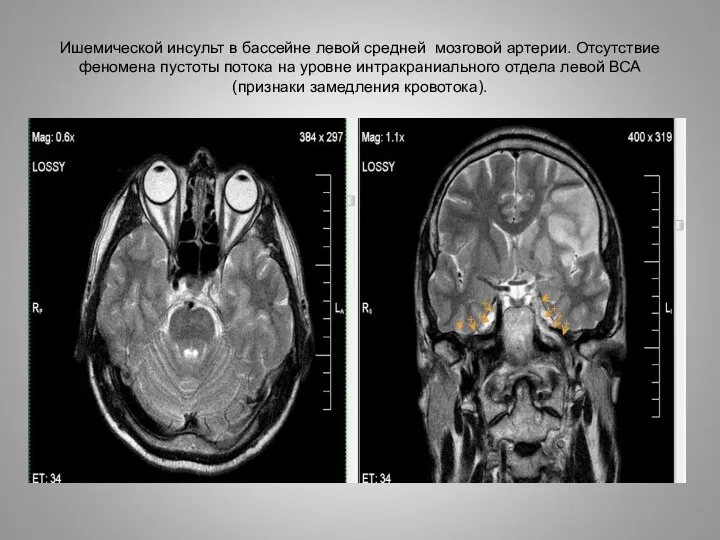 Ишемической инсульт в бассейне левой средней мозговой артерии. Отсутствие феномена