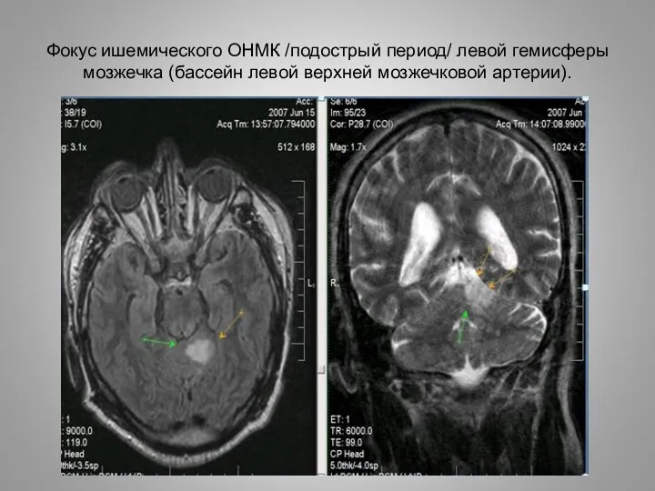 Фокус ишемического ОНМК /подострый период/ левой гемисферы мозжечка (бассейн левой верхней мозжечковой артерии).