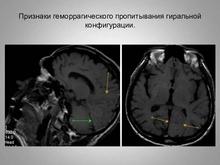 Признаки геморрагического пропитывания гиральной конфигурации.