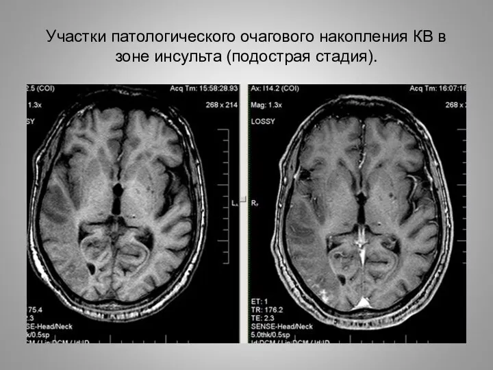 Участки патологического очагового накопления КВ в зоне инсульта (подострая стадия).