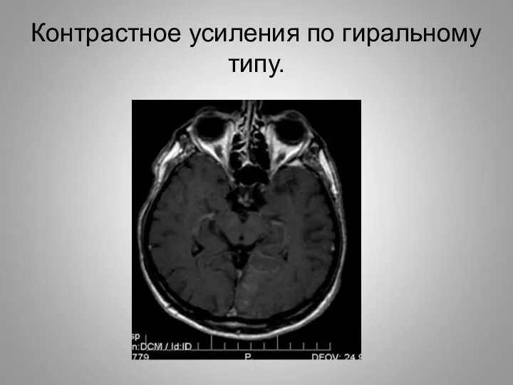 Контрастное усиления по гиральному типу.