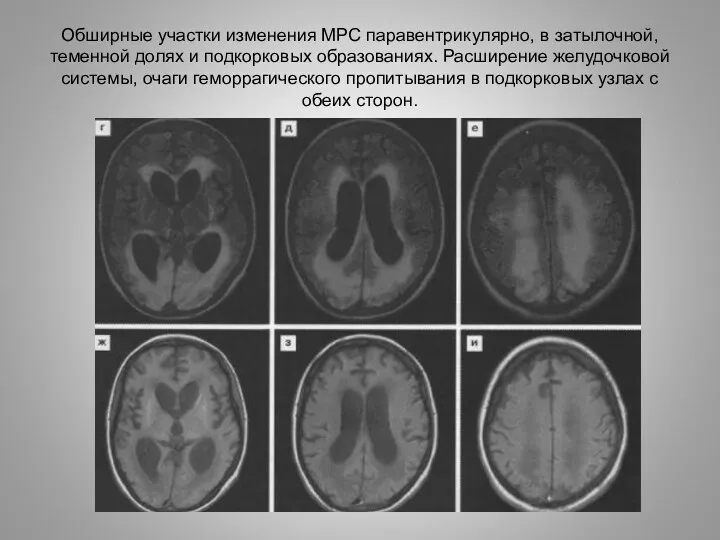 Обширные участки изменения МРС паравентрикулярно, в затылочной, теменной долях и