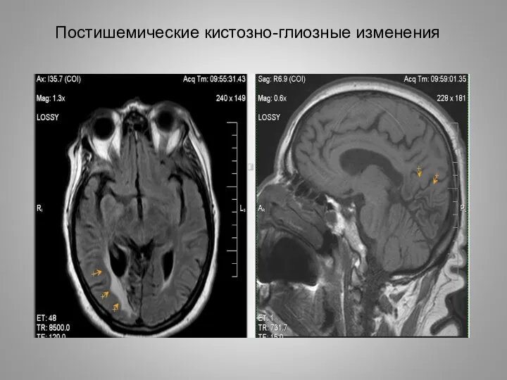 Постишемические кистозно-глиозные изменения