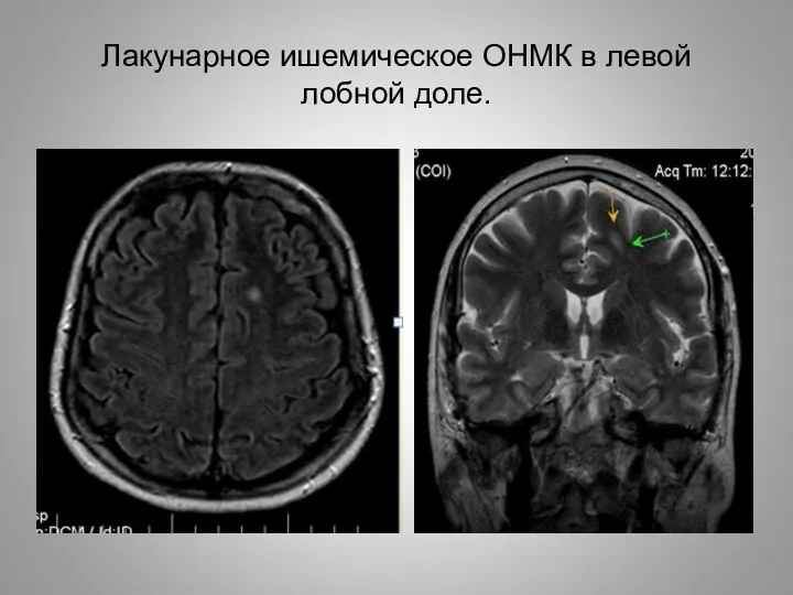 Лакунарное ишемическое ОНМК в левой лобной доле.