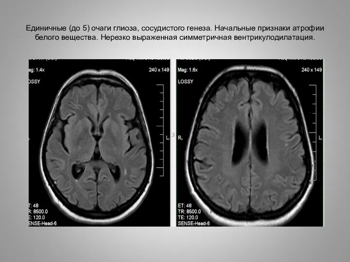 Единичные (до 5) очаги глиоза, сосудистого генеза. Начальные признаки атрофии белого вещества. Нерезко выраженная симметричная вентрикулодилатация.