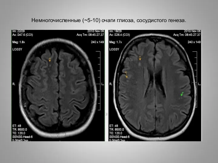 Немногочисленные (~5-10) очаги глиоза, сосудистого генеза.