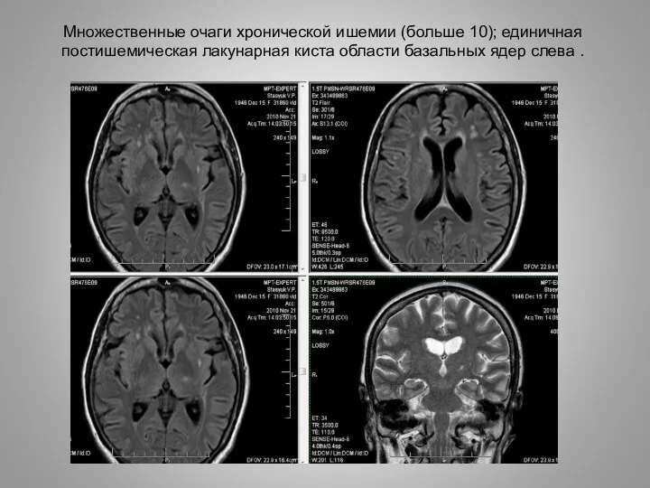 Множественные очаги хронической ишемии (больше 10); единичная постишемическая лакунарная киста области базальных ядер слева .